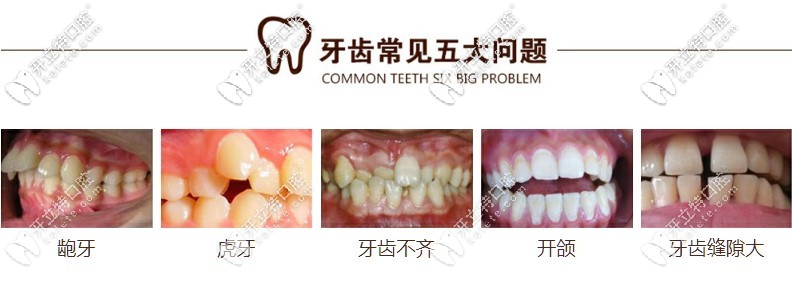 需要做矯正的各類牙齒畸形情況