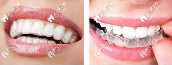 時(shí)代天使隱形牙套矯正器