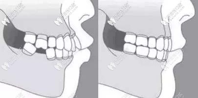 年輕人后牙缺失該選擇美國3i種植體的哪個型號？