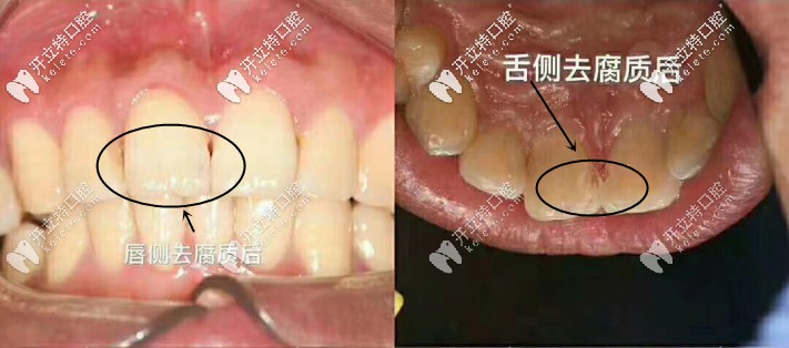 去腐質(zhì)后的舌唇側(cè)