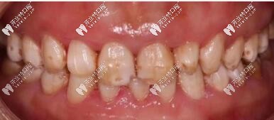 氟斑牙別指望冷光美白變白,說下我做義獲嘉瓷貼面的感受