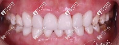 昆山美奧張牙齒貼面案例 昆山美奧張牙齒貼面案例