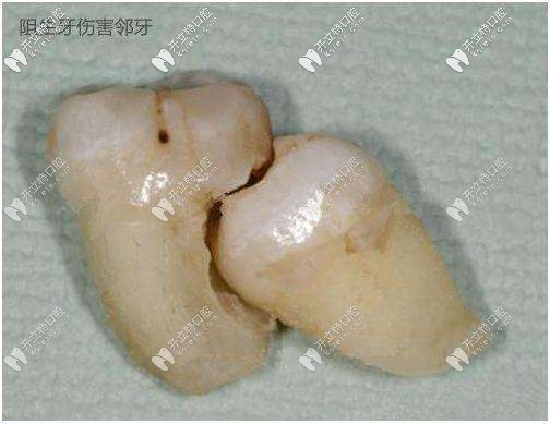 阻生智齒圖片