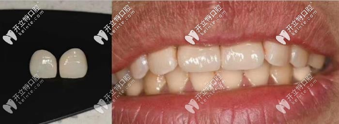 牙齒瓷貼面做了會(huì)后悔?那是你沒看到我的貼面效果圖喲