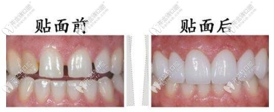 牙齒貼面前后對比照