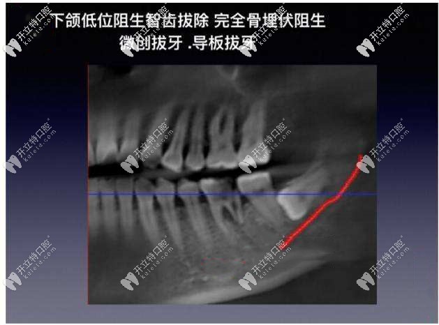 下頜低位阻生智齒圖片