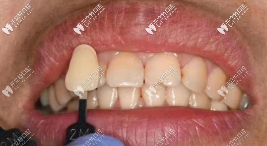 貼面中的牙齒比色