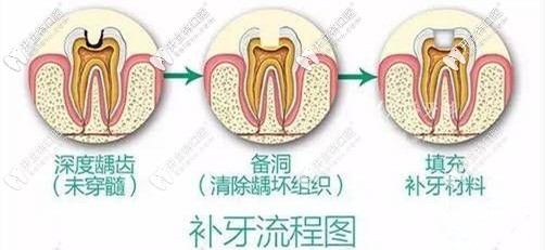 你們要的補(bǔ)牙流程圖來(lái)咯