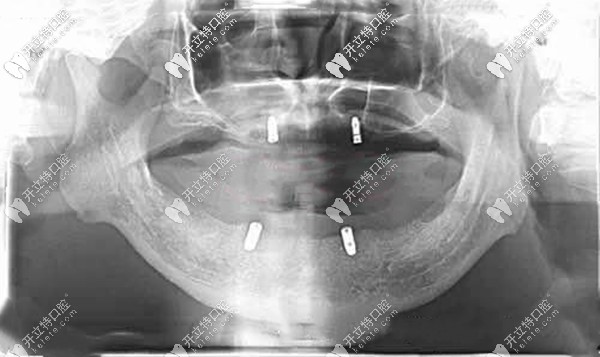 Locator全口種植覆蓋義齒的優(yōu)缺點(diǎn)