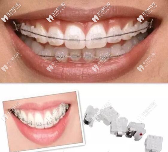 陶瓷自鎖托槽牙套矯正