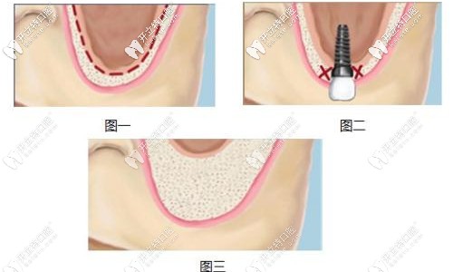 上頜竇提升術的優(yōu)缺點