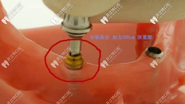 Locator種植覆蓋義齒的咬合力