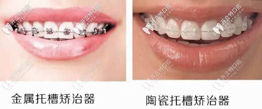 金屬托槽和陶瓷托槽對比