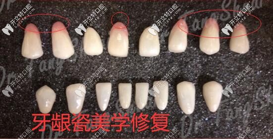 牙齦瓷美學(xué)修復(fù)北京雅醫(yī)家口腔