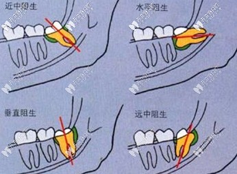 阻生智齒會引發(fā)的危害 阻生智齒會引發(fā)的危害