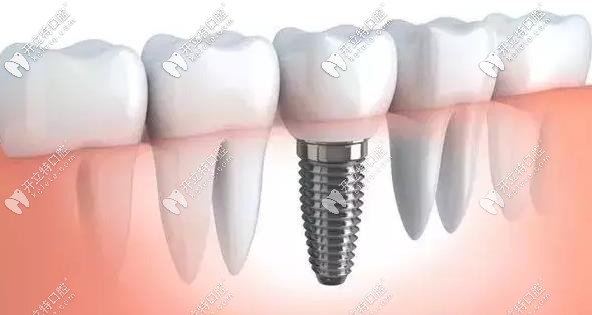 種植牙