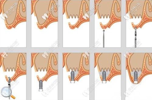 <!--<i data=20240703-sp></i>-->民講解種植修復中的骨劈開和骨擠壓手術