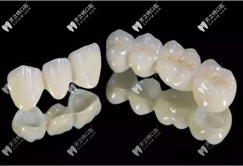全瓷牙修復(fù)