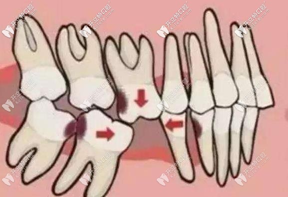 牙齒錯頜畸形 牙齒錯頜畸形