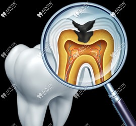 局部清潔死角可能會引發(fā)齲齒 局部清潔死角可能會引發(fā)齲齒