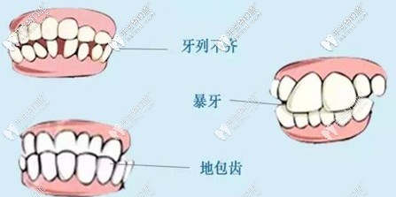 牙列不齊對面貌和咬合都有影響