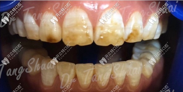 怕做16顆烤瓷牙摘除后牙壞,我的四環(huán)素牙用了全瓷貼面修復(fù)