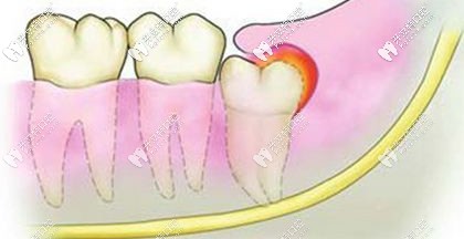 可能引發(fā)智齒冠周炎 可能引發(fā)智齒冠周炎