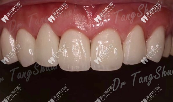 我的貼面效果圖