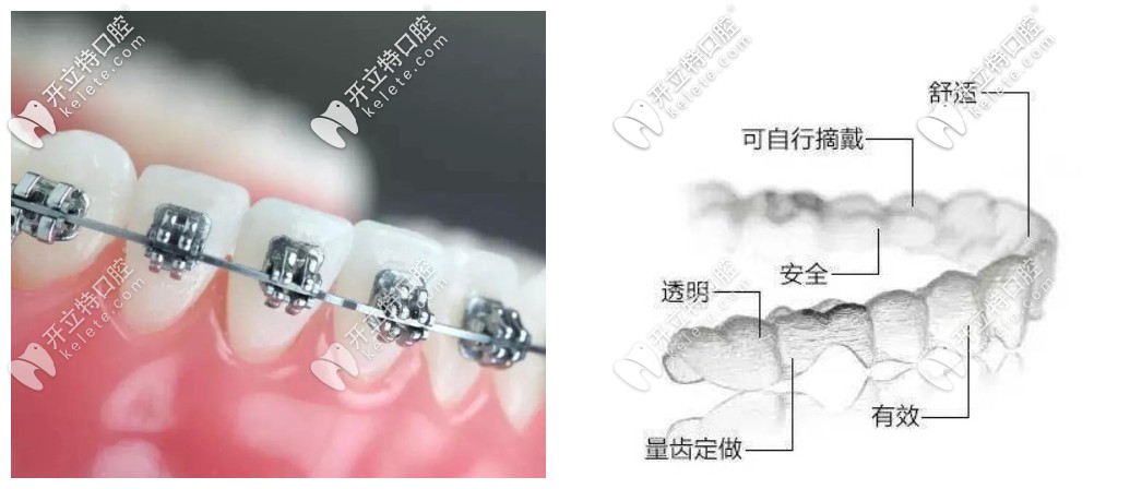 矯正齙牙隱形牙套和鋼絲哪個更快?利弊分析后發(fā)現(xiàn)區(qū)別是…