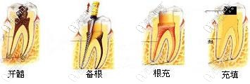 開髓、備根、根充以及填充