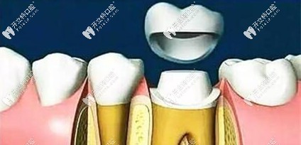 安裝牙冠后完成牙體修復