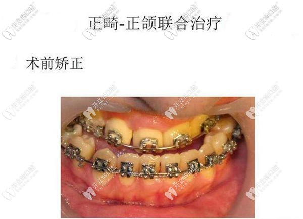 正頜手術(shù)前正畸的目的是什么