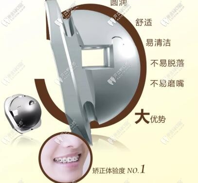 球托(OBrace)自鎖托槽的優(yōu)勢(shì)