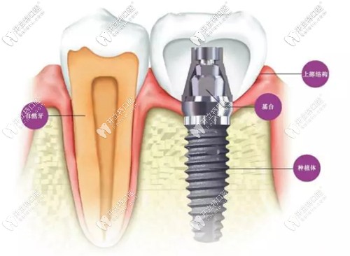 關(guān)于前牙選擇即刻種植修復(fù)的好處