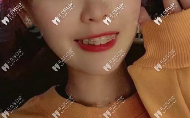 門牙齙牙戴陶瓷自鎖牙套矯正380天，大家看我嘴巴還凸嗎