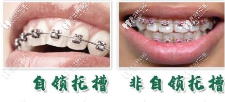 細(xì)說(shuō)國(guó)產(chǎn)自鎖托槽品牌歐睛和OBrace球托的區(qū)別及價(jià)格