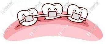 更換弓絲是否會(huì)收費(fèi)