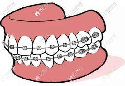 原來傳統(tǒng)鋼絲矯正一副多少錢，跟牙套上的弓絲有關啊