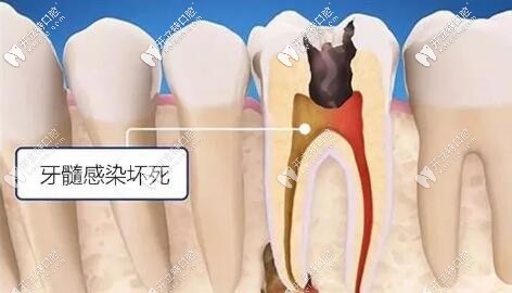 牙髓感染根管治療