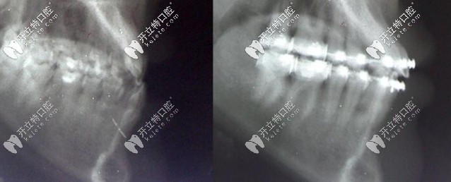 用帶狀弓矯正器矯正骨性Ⅲ類錯合矯治前后
