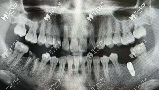 伊諾種植體<span style=