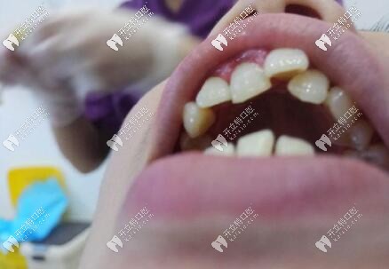 ?？谖⑿谇会t(yī)院正畸案例