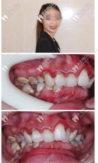 牙不齊深覆合3m自鎖托槽矯正5個(gè)月,點(diǎn)贊?？谶@家高大上牙科