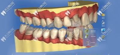 3D手術(shù)導(dǎo)板打印