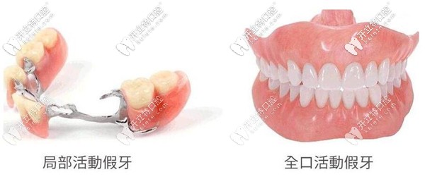 活動假牙的價格