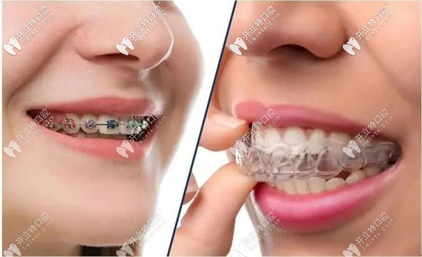 帶了鋼絲牙套后悔的人,快來看這隱形透明牙套多少錢