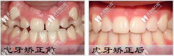 給深圳的菇?jīng)鰝?暢談我戴時(shí)代天使隱形牙套矯正虎牙的感受