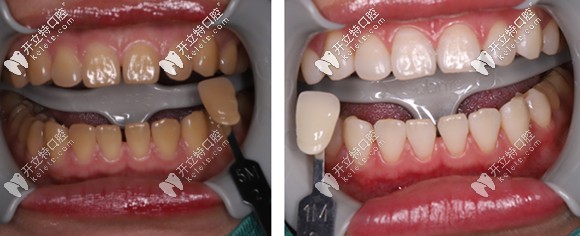 做完一個療程的冷光美白，牙齒色號由5M贈白到1M