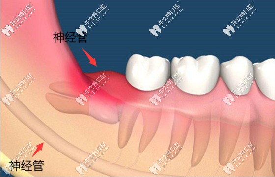 三亞拔智齒的價(jià)格為500元起