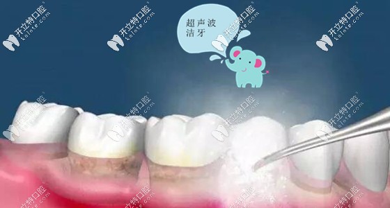 在三亞市洗牙要多少錢呢